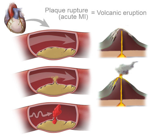 Illustration comparing plaque rupture and heart attack to a volcanic eruption